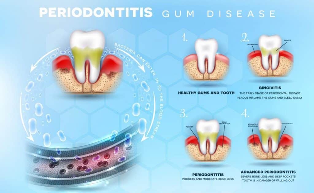Periodontitis & Gum Therapy​