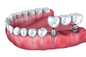 Implant Supported Bridges