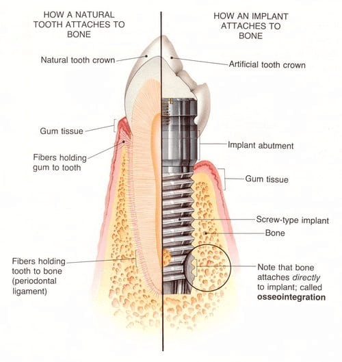 DENTAL IMPLANTS