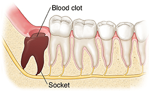 blood clot wisdom teeth bad