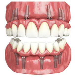 Implant Dentures