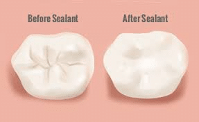 pediatric care sealants