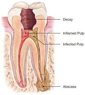 Root Canal